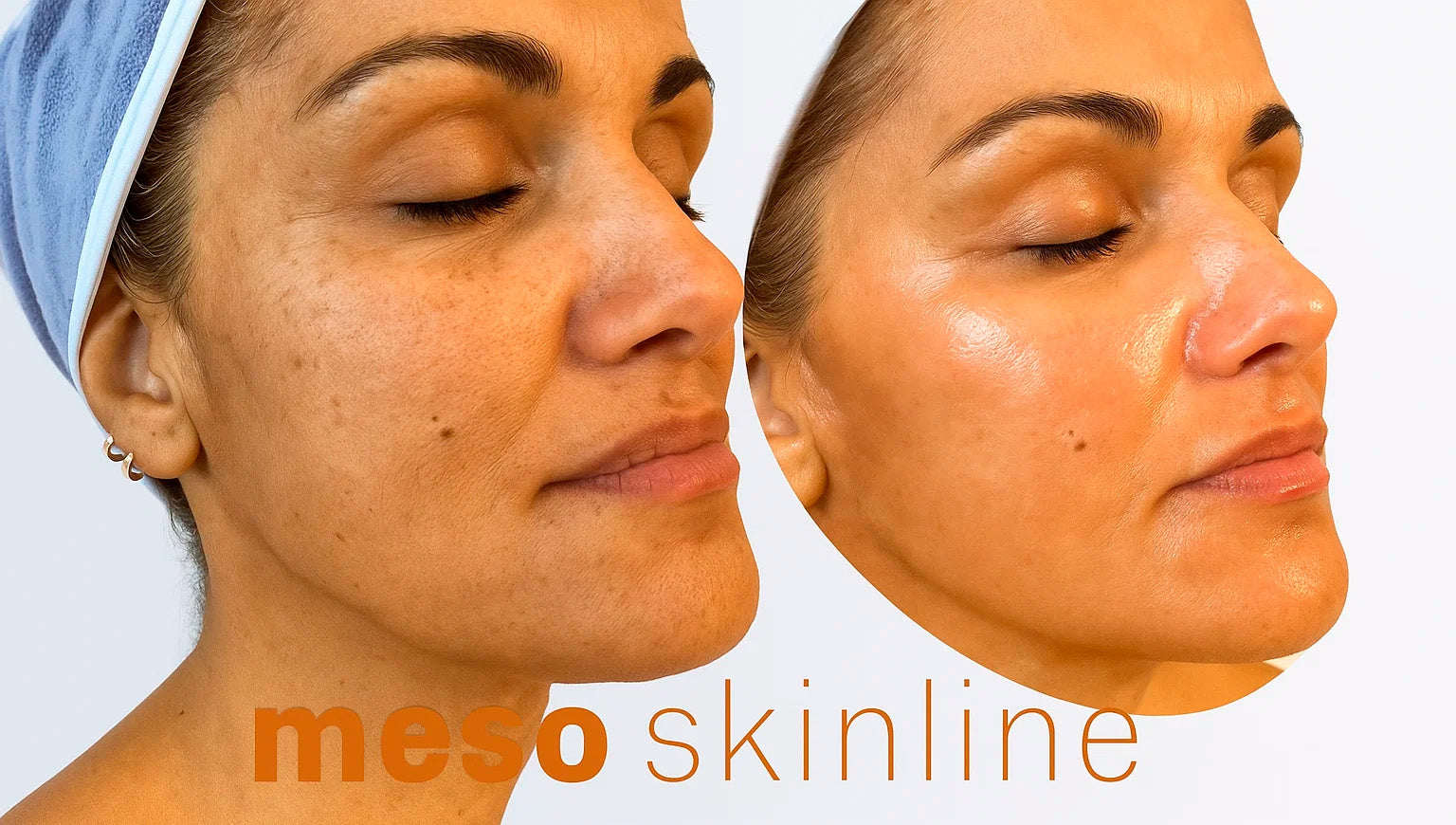Meso Kits: Delivering What Skin Actually Needs